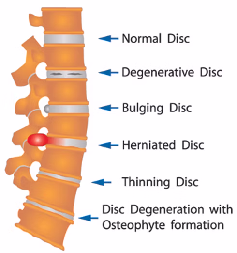 Alternative Chiropractic treats herniated discs